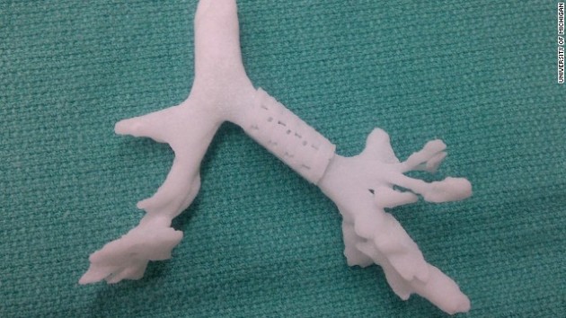 Splint made using 3D Printer